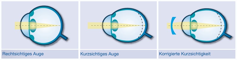 mueller_welt-kontaktlinsen_illu_kurzsichtigkeit