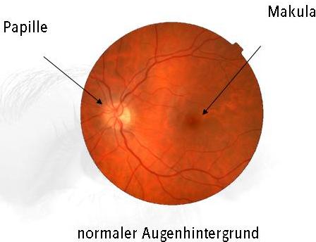mueller_welt_kontaktlinsen_grafik_frueherkennung