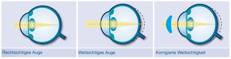 mueller_welt_kontaktlinsen_illu_weitsichtigkeit