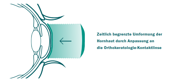 orthokeratologie_auge