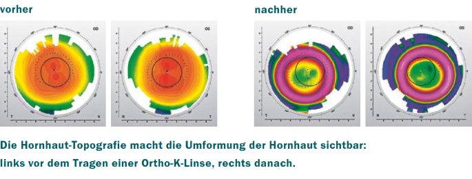 orthokeratologie_hornhaut-topografie