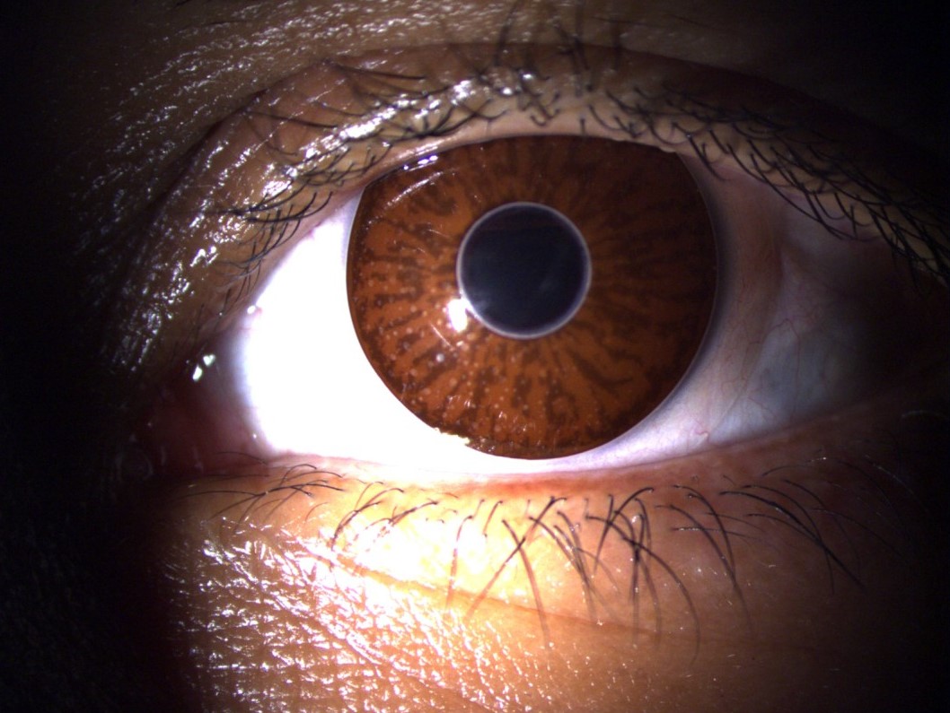 Irislinse