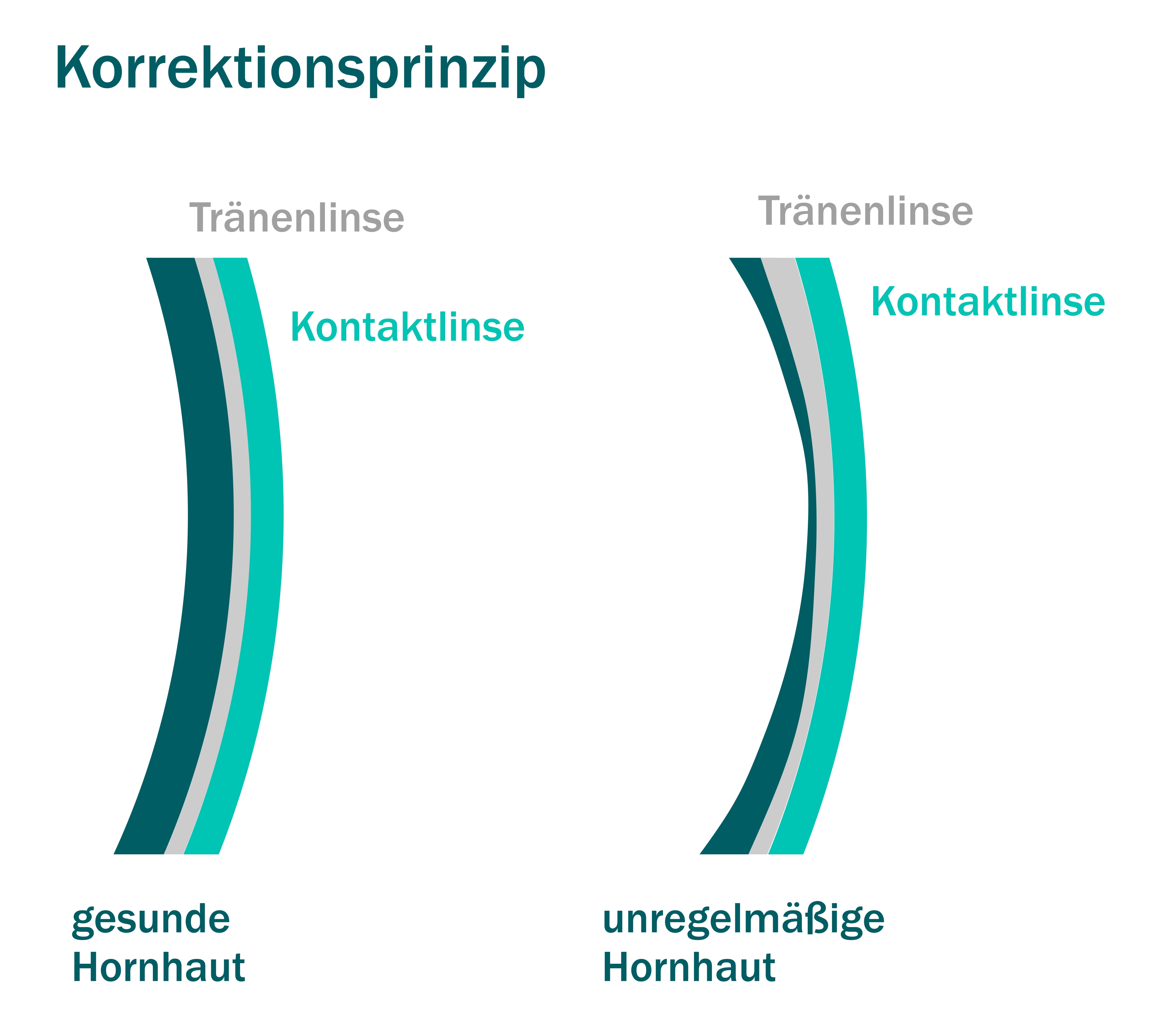 Korrektionsprinzip unregelmäßige Hornhaut