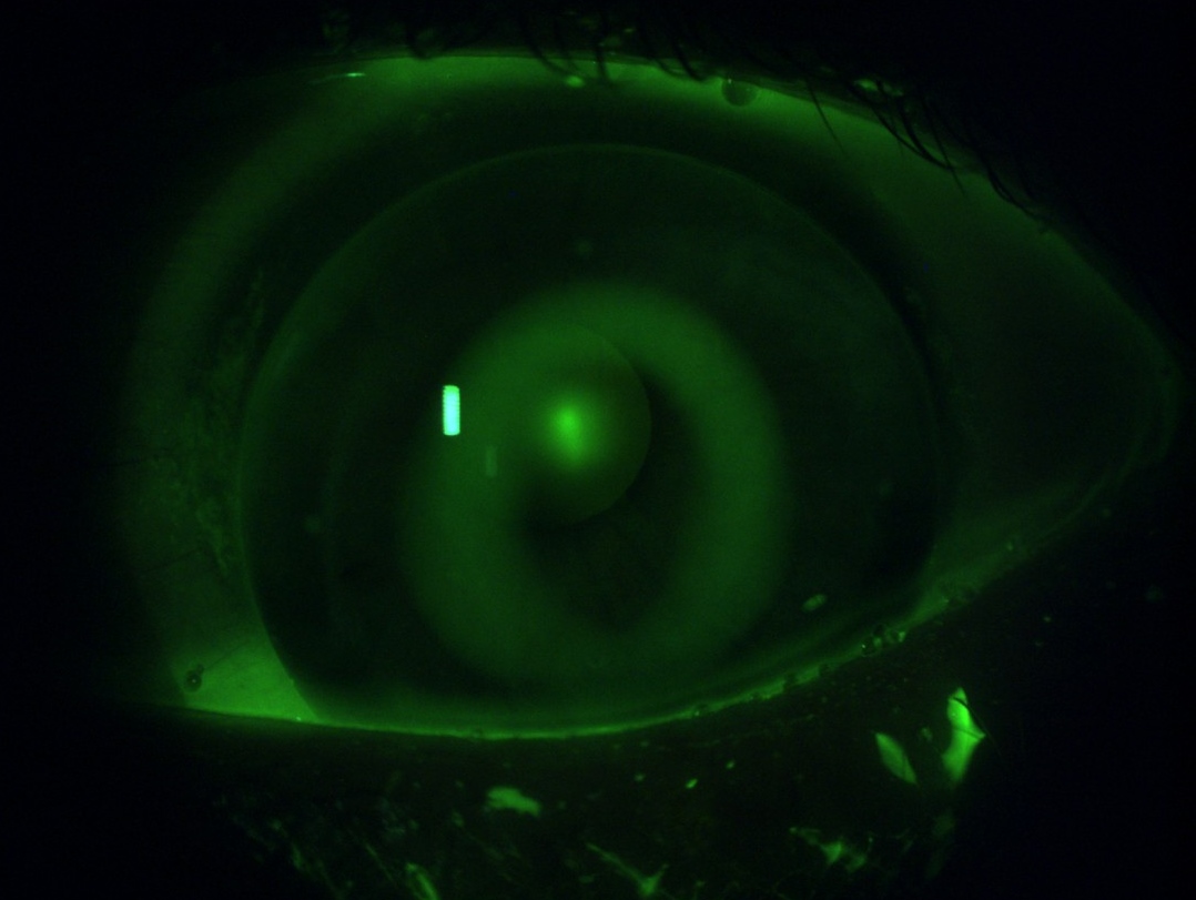Fluobild_corneal_Start