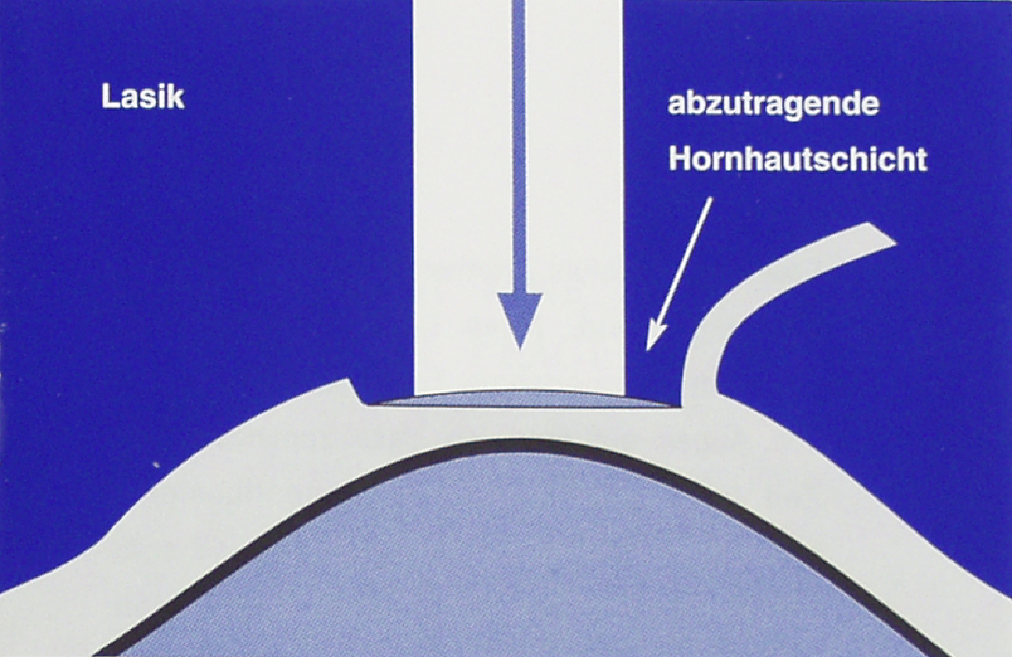 mueller_welt_kontaktlinsen_grafik_lasik