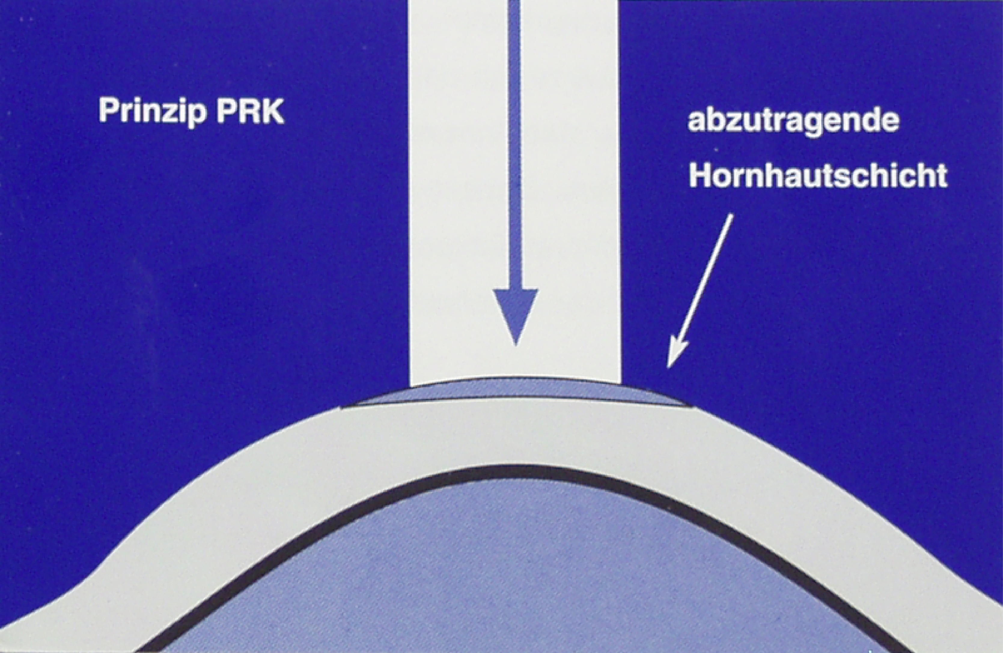 mueller_welt_kontaktlinsen_grafik_prk