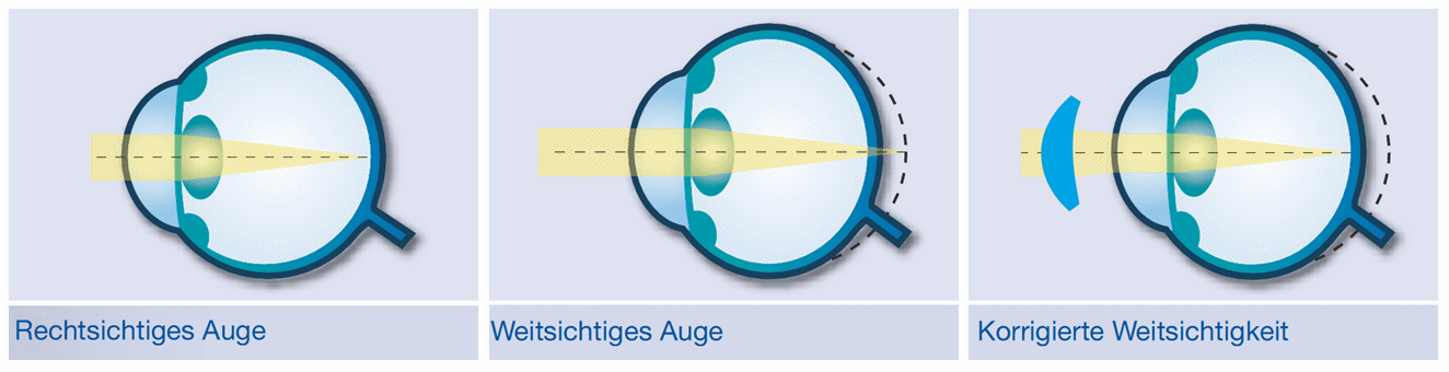 mueller_welt_kontaktlinsen_illu_weitsichtigkeit