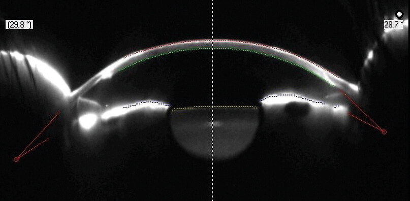 Perforierende Keratoplastik Pentacam