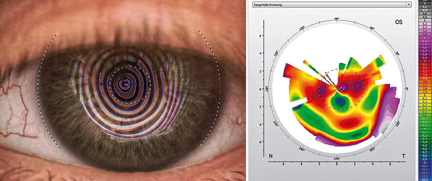 Perforierende Keratoplastik Topographie