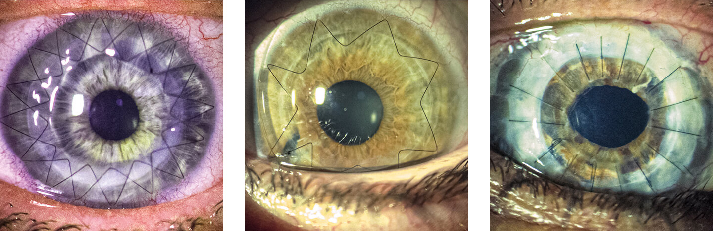 Mueller-Welt-Keratoplastik-naehte