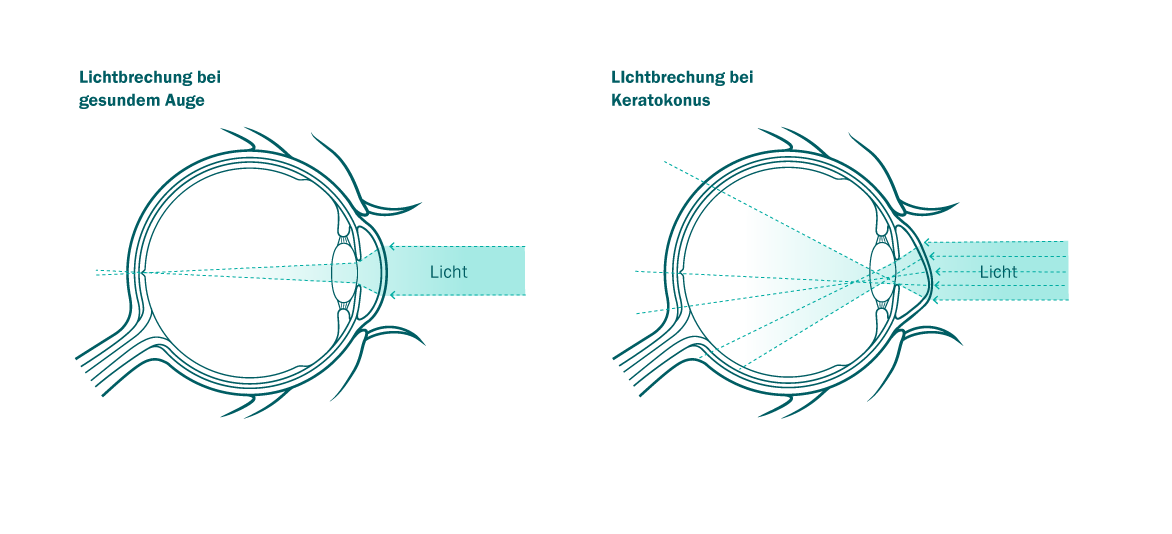 grafik1_keratokonus1_RGB_dawi