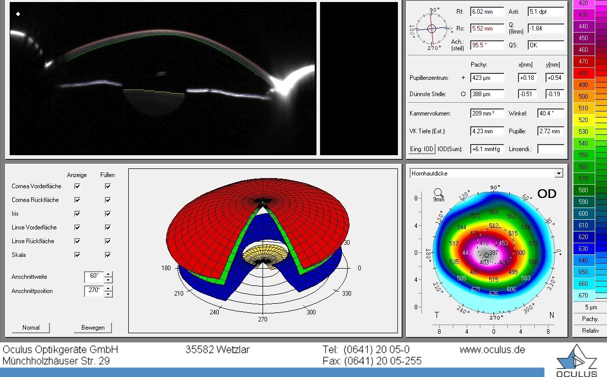 typische Messung Hornhautdicke und OberflÑche bei Keratokonus