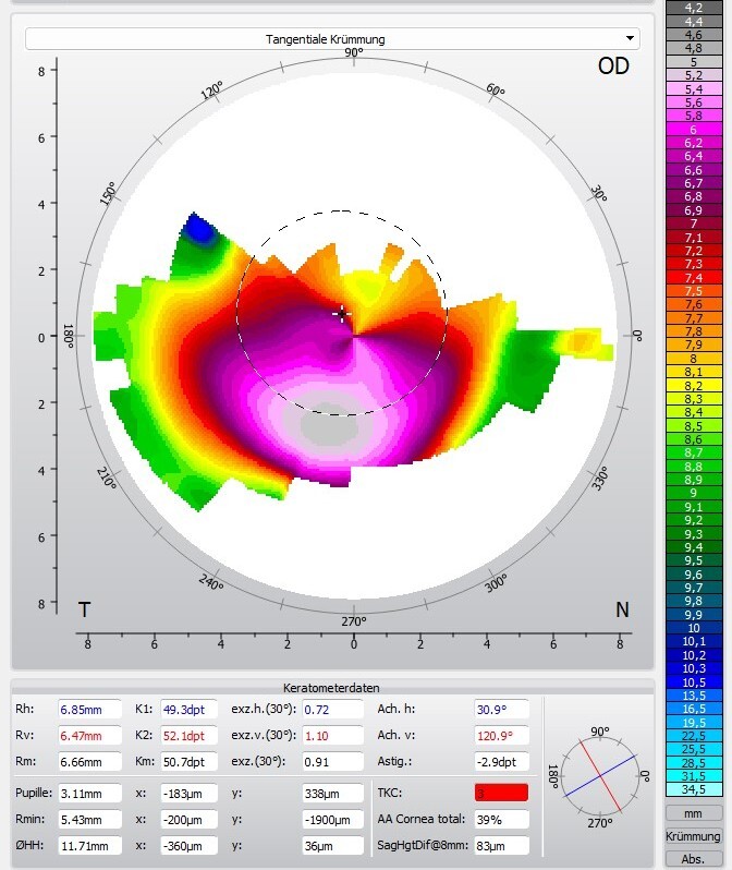 Topographie Keratokonus