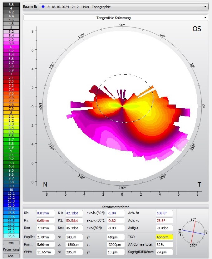 Topographie Keratoplastik