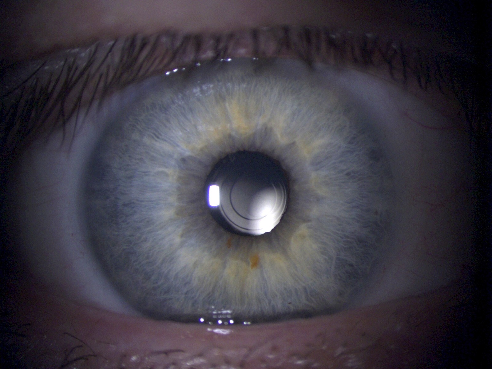 multifokale Intraokularlinse