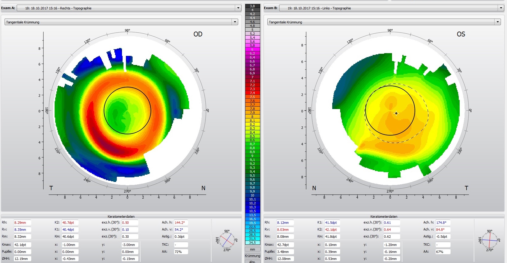 Myopie-Management mit Orthokeratologie an nur einem Auge